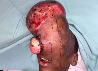 Cavadas-Niño Emmanuel, con el tumor en la cabeza