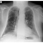 radiografía de torax