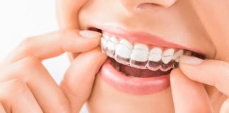 Los odontólogos alertan sobre el uso de alineadores dentales