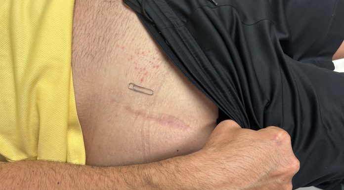 Vithas Valencia Turia refuerza su apuesta por la experiencia paciente e incorpora una técnica de vanguardia en cirugía de prótesis de cadera