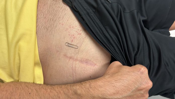 foto cicatriz operación cadera anterior