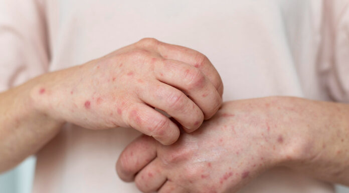 El herpes zóster aumenta en la Comunitat Valenciana: una enfermedad frecuente, dolorosa y aún poco conocida