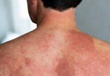 Sanidad confirma un brote de sarampión en la Comunitat: 16 casos confirmados en adultos Sarampión en una persona adulta