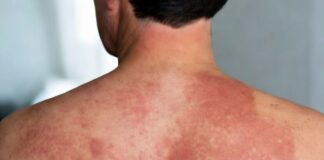 Sarampión en una persona adulta