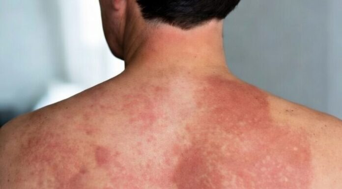 Sanidad confirma un brote de sarampión en la Comunitat: 16 casos confirmados en adultos Sarampión en una persona adulta