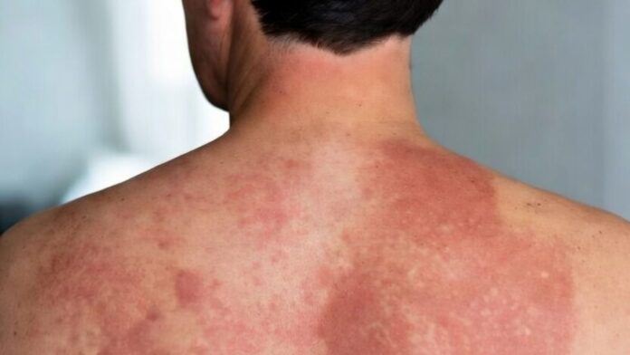 Sarampión en una persona adulta